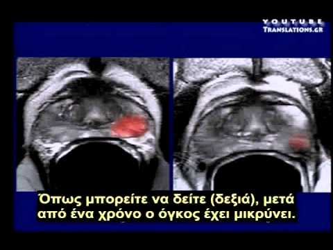 Η Δυτική διατροφή σκοτώνει (ομιλία του Δρα Ornish στο TED)